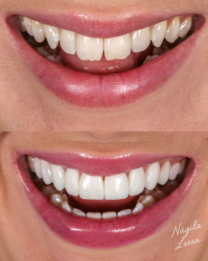 Antes e depois de facetas de resina — Dra. Nágila Lessa