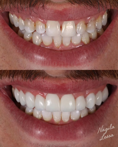 Antes e depois de facetas de resina — Dra. Nágila Lessa