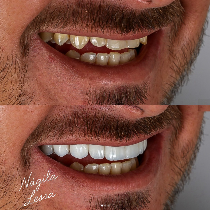 Antes e depois de facetas de resina — Dra. Nágila Lessa