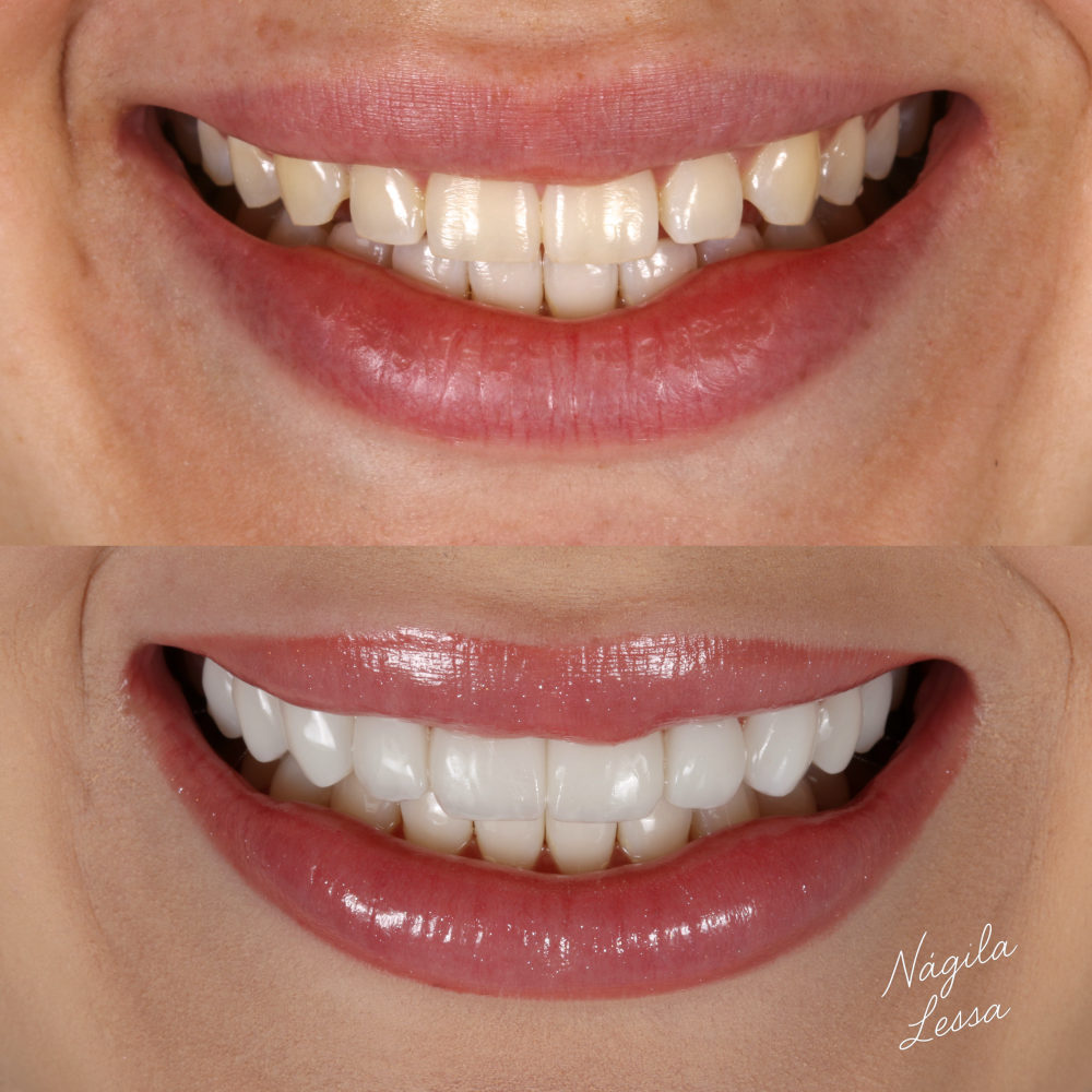 Antes e depois de facetas de resina — Dra. Nágila Lessa