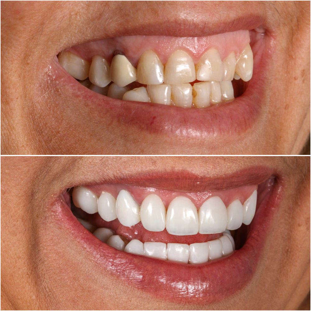 Antes e depois de facetas de resina — Dra. Nágila Lessa