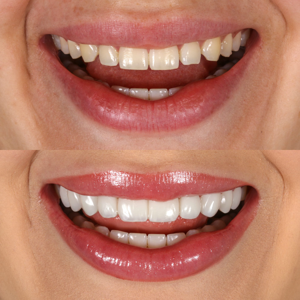 Antes e depois de facetas de resina — Dra. Nágila Lessa