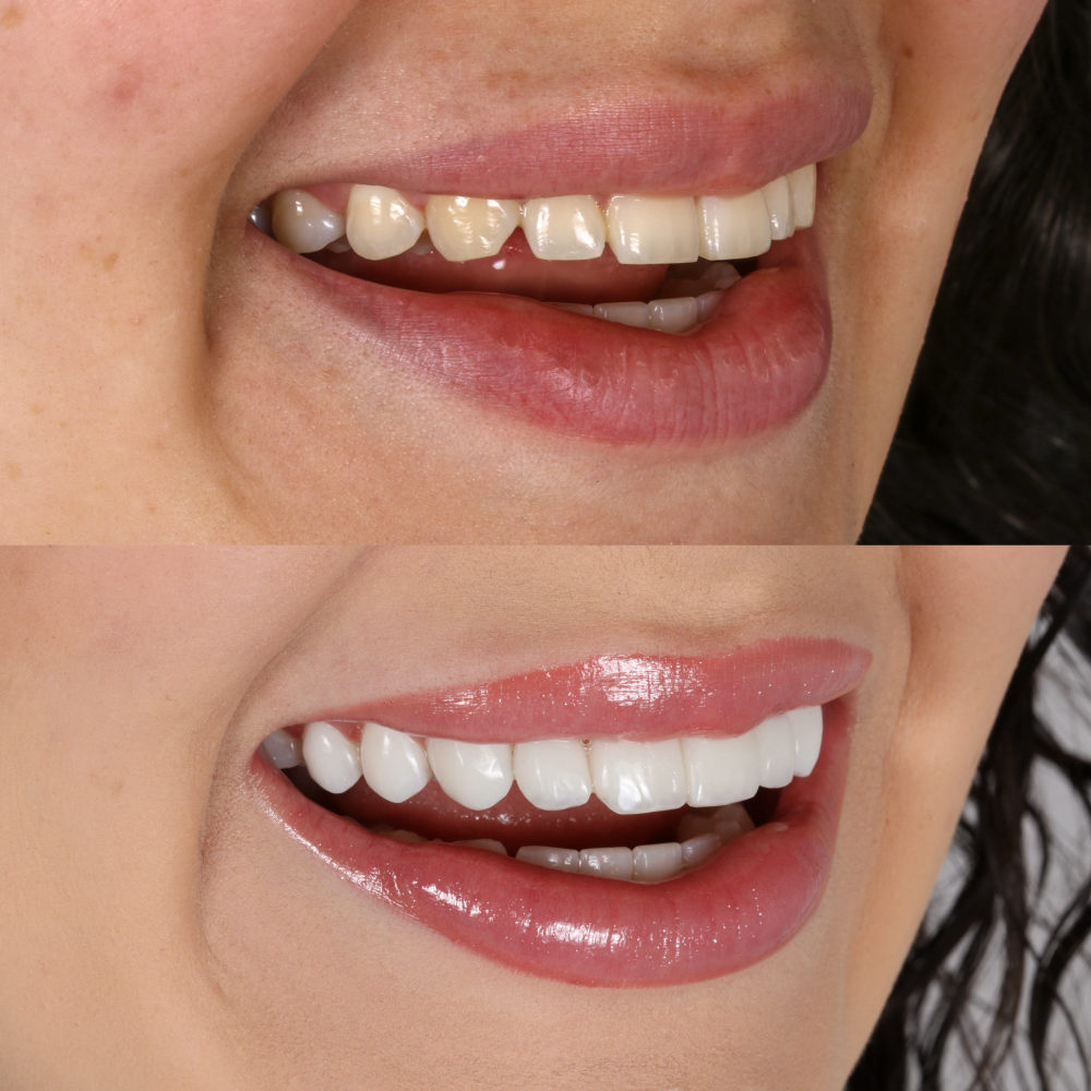 Antes e depois de facetas de resina — Dra. Nágila Lessa